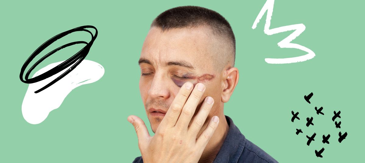 How to Get Rid of a Black Eye Fast: Tips for Quick Relief
