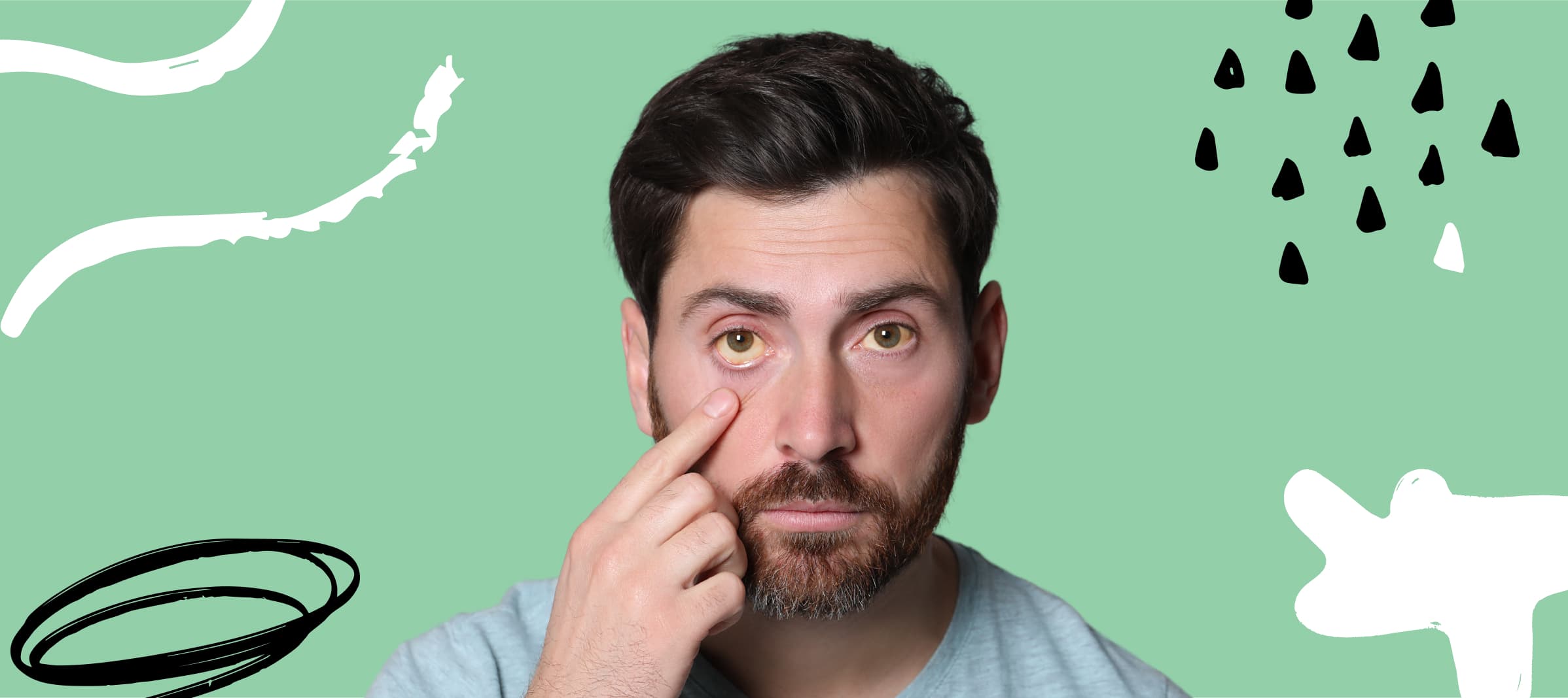 Causes of Eye Discoloration in the White Part - CorneaCare