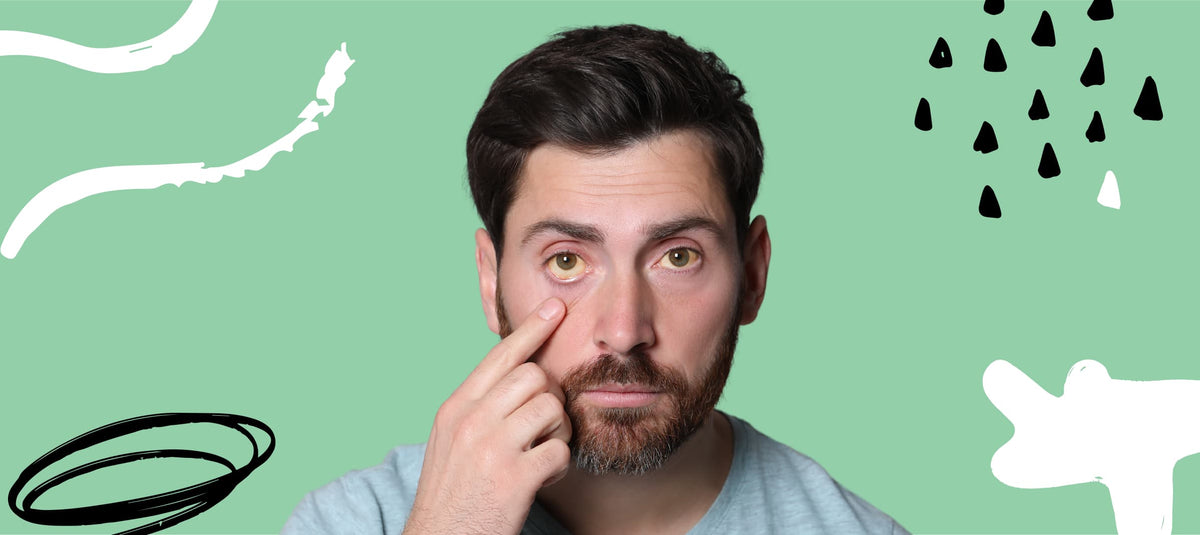 Causes of Eye Discoloration in the White Part