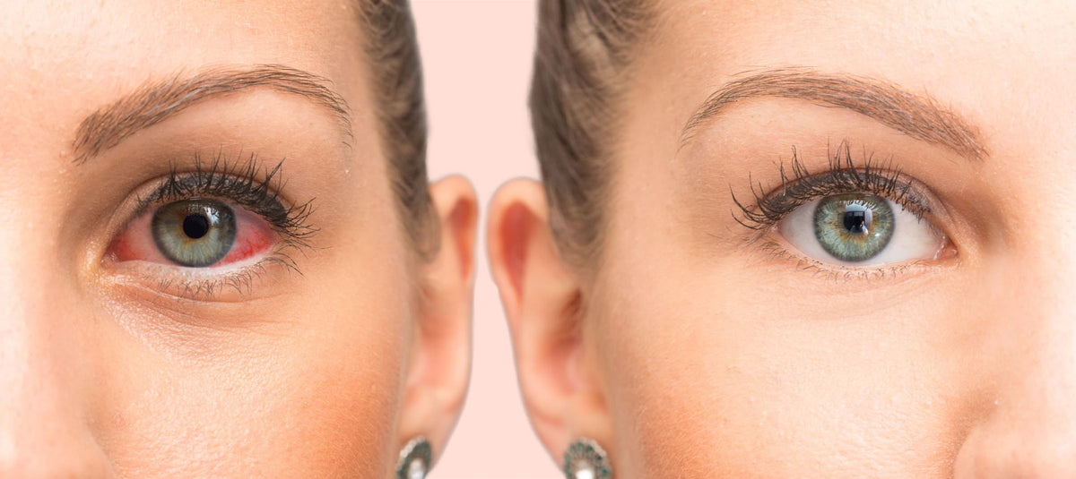 Pink Eye vs. Dry Eye: What’s the Difference?